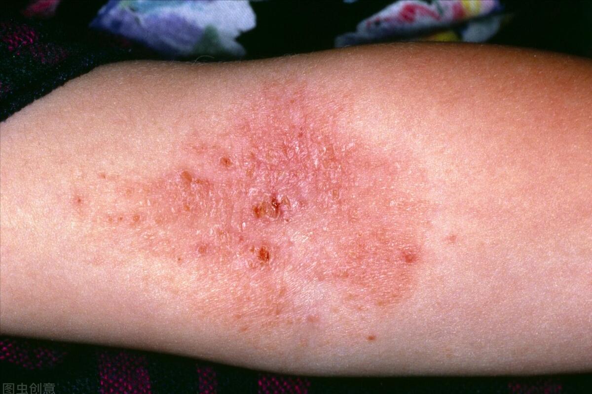 为什么湿疹反反复复这么顽固,为什么湿疹反反复复