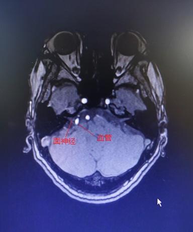 眼皮老是跳怎么回事？神经科医生：这个病要警惕了