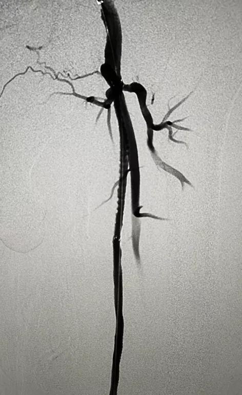 下肢血管引起的腿软无力,下肢动脉闭塞会引起腿无力吗