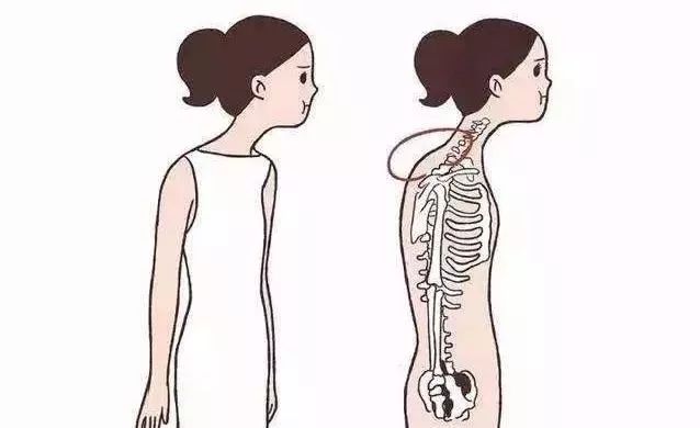 乌龟脖可以改善吗,如何矫正乌龟脖