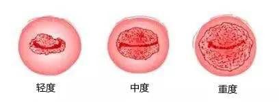 宫颈3度糜烂能治好吗,宫颈糜烂能治好吗要治多久