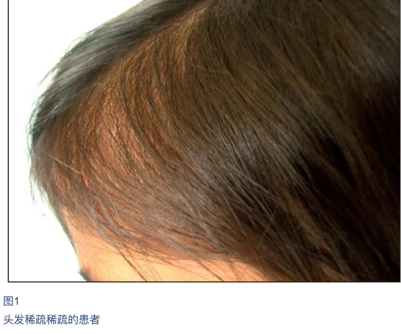 儿童脱发会是什么病的前兆,孩子毛囊引起的脱发怎么办