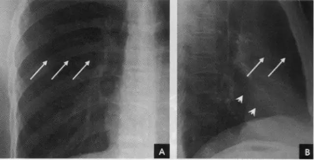 休闲小白鞋夏,献血小板相当于献血多少