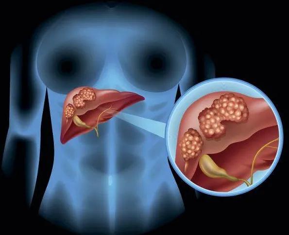 发现肚子有肿瘤怎么办,发现肚子硬硬的是什么原因