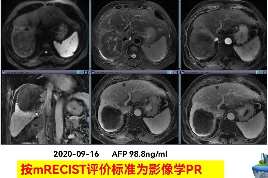 肝癌晚期靶向治疗怎么做,中国肝癌tace治疗展望
