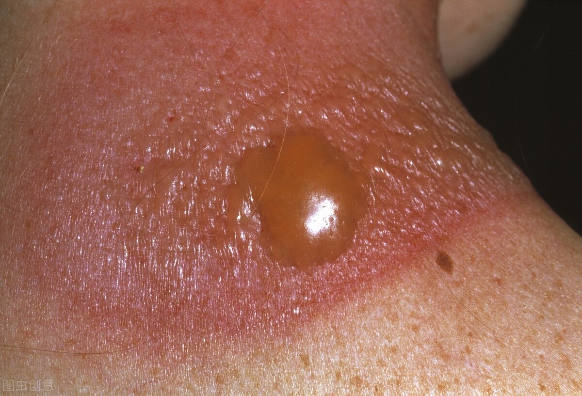 糖尿病伤疤好了有黑印怎么办,糖尿病身上的疤痕不容易好