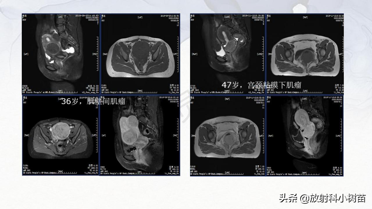 女性盆腔mri解剖图谱,泌尿生殖系统x线解剖