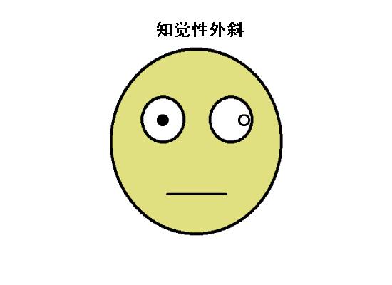 正常眼位和斜视眼位,斜视眼的几大症状