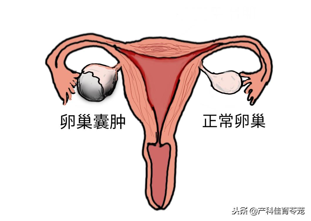 卵巢囊肿做了肿瘤标志物显示正常,卵巢囊肿内见密集光点正常吗