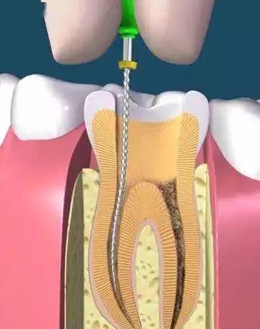 12岁牙齿有黑线怎么办自己怎么治,牙齿有黑线怎么预防不发展成龋齿