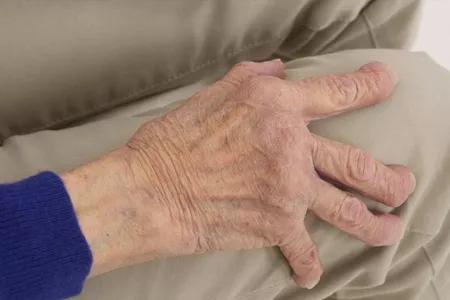 十年的类风湿还能治好需要多少钱,类风湿是不是永远治不好了