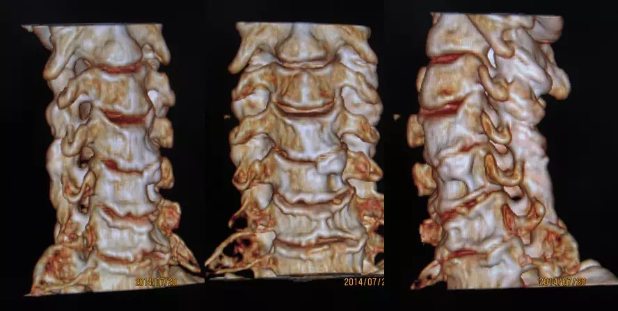 颈椎腰椎疾病ct及mri诊断,腰椎ct可以发现肠部病变吗