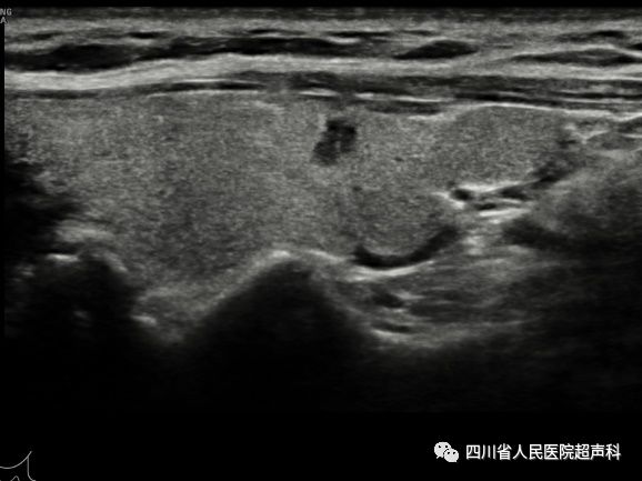 为啥有甲状腺微小乳头状癌（PTMC）过度治疗一说？