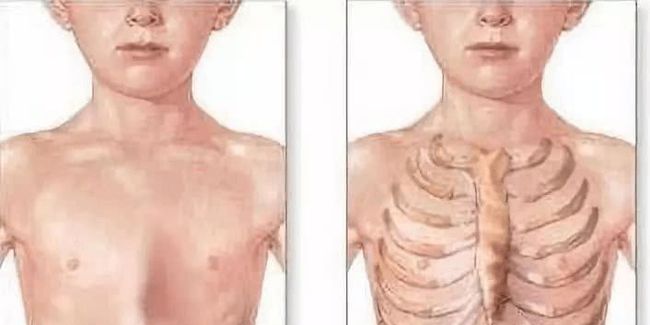 儿童的胸骨大小不一样怎么办,儿童前胸骨凸出来怎么回事