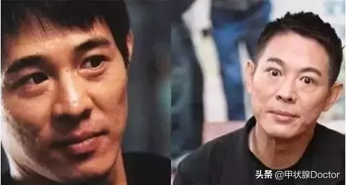 现在有治疗甲亢突眼的药吗,甲亢突眼有什么好的药物治疗