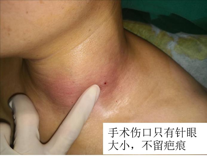 甲状腺结节微创消融手术,甲状腺结节微创消融医保