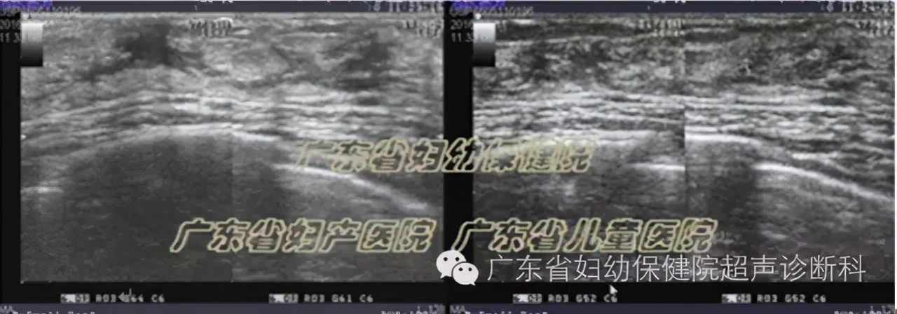 青春期乳腺正常情况,乳腺发育的特征