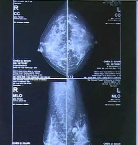 按摩乳房骗局揭秘内幕,乳房按摩是不是骗人的
