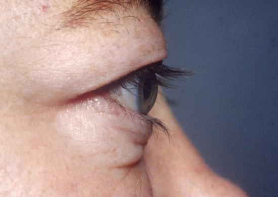 甲亢引起的眼球突出多久能恢复,甲亢导致眼球突出四五年了