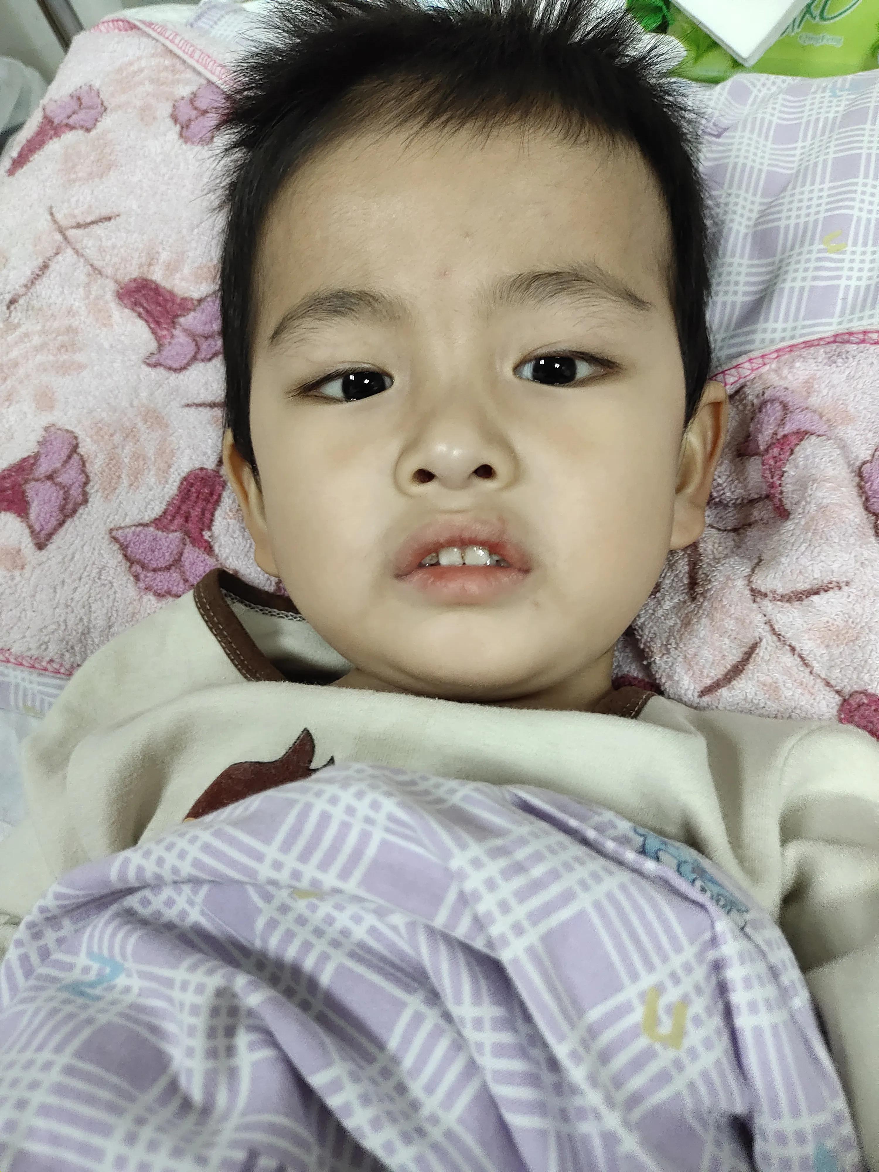 小儿化脓性脑膜炎会有后遗症吗,宝宝化脓性脑膜炎