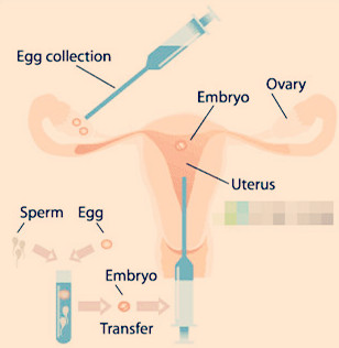胚胎移植后该不该立马上厕所?
