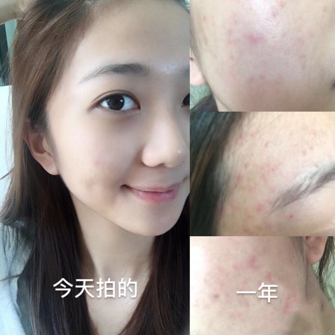 超强祛痘攻略养成不长痘肌肤,祛痘全攻略脸上痘痘真的干净了
