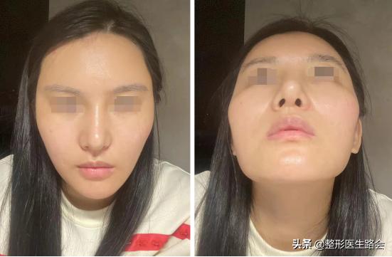 做的耳软骨鼻塌下去了怎么修复啊,做了耳软骨鼻如何不塌