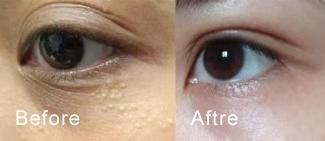 别再用针挑！用米澳拉，脂肪粒自己“掉”下来，效果胜过医美激光