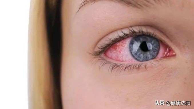 干燥综合症的日常,健康科普堂春季过敏性疾病及防治