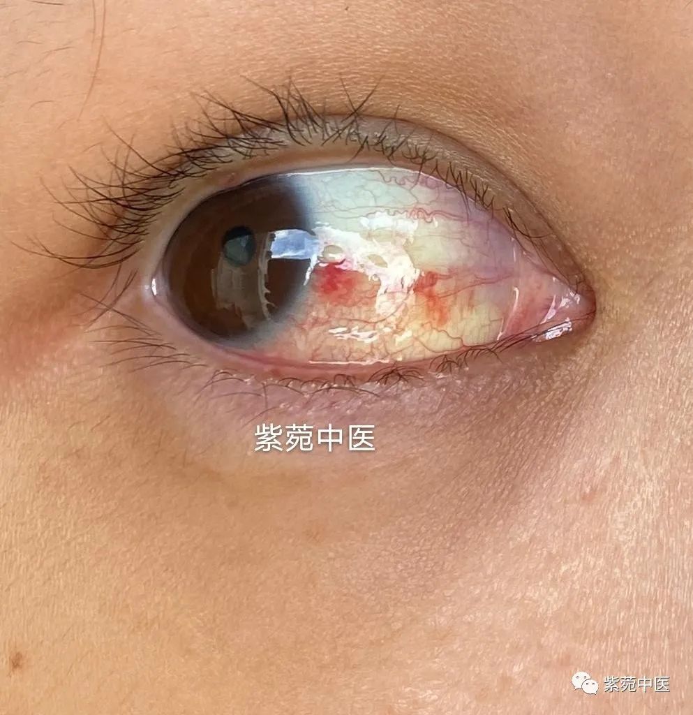 长期戴隐形眼镜、看电脑，眼睛又红又痒？医生：上甘草泻心