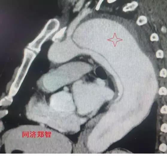 磁共振可以替代cta检查主动脉夹层,主动脉夹层cta上如何分辨真假腔