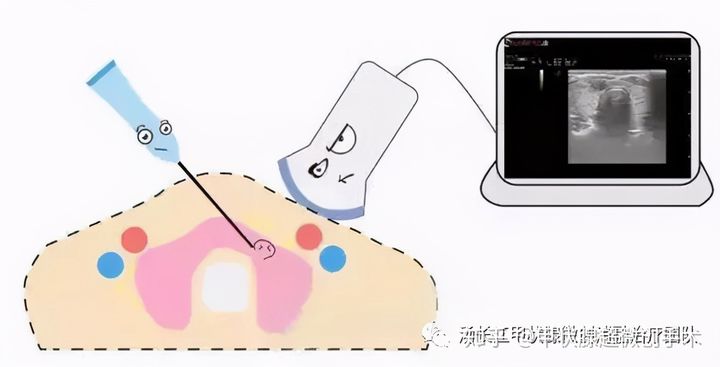 微波消融术后死亡的肿瘤怎么处理,微波消融治疗肿瘤的原理