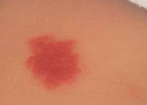 宝宝身上有不光滑胎记,宝宝身上胎记不哭就没有