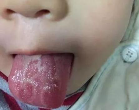 宝宝舌苔缺几块,舌头边舌苔缺了是什么症状