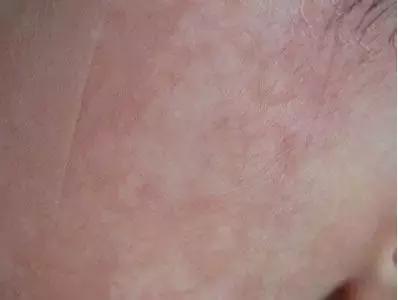 孩子脸花一块白一块怎么回事,小孩脸上花一块怎么回事