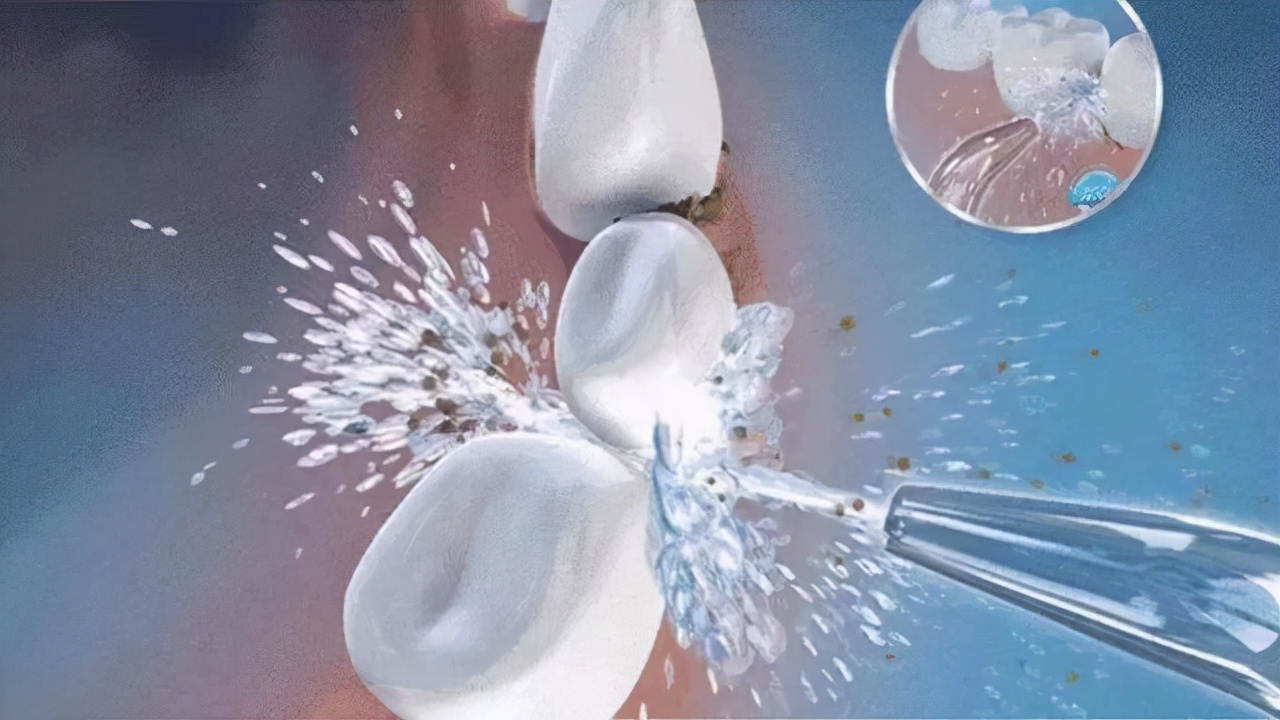 牙结石洗掉后牙缝大可以恢复吗,牙结石清除后牙缝怎么处理