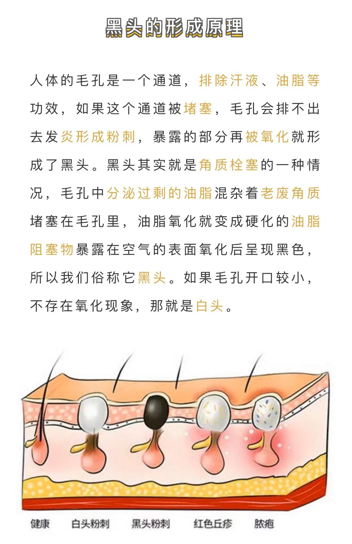 黑头到底有没有方法改善,你不知道的小知识黑头