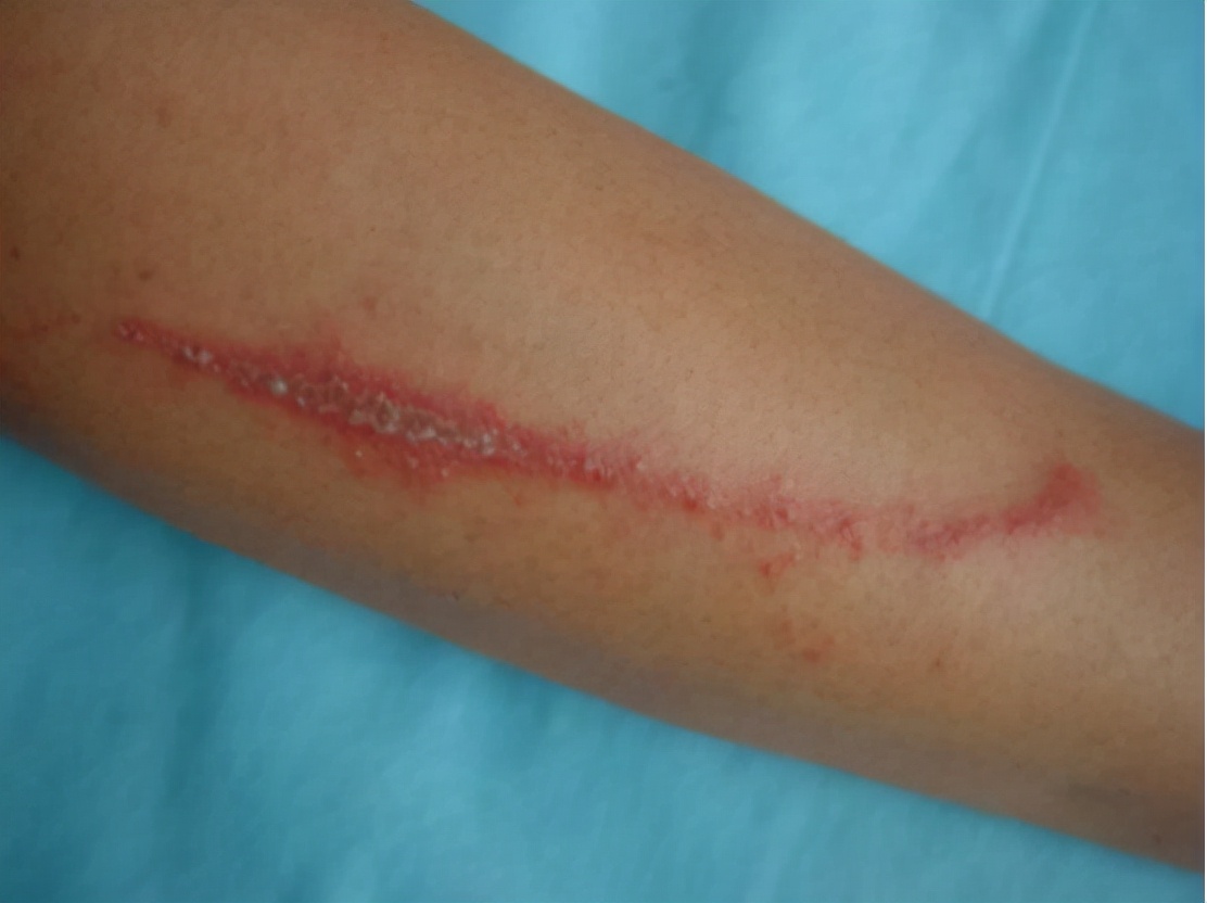 被隐翅虫毒液沾到涂什么药膏,被隐翅虫咬伤特效药