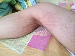 产后妊娠纹怎么去除,产后祛除妊娠纹最有效的方法