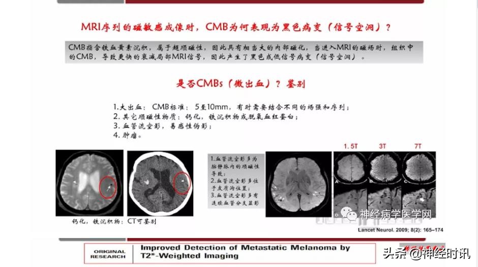 缺血性脑血管病出血评估,脑血管微出血怎么治疗