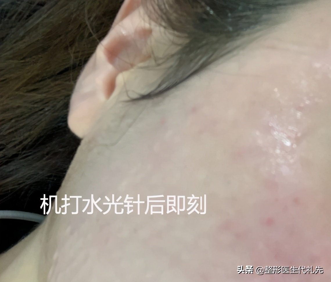 打美白水光针几次可以看到效果,水光针用哪种针注射好