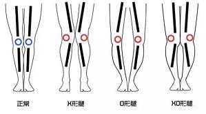 懒人腿如何变直,怎么矫正腿型x型腿