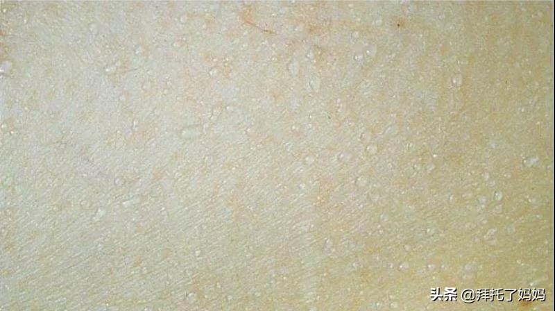 预防痱子小窍门,热痱和痱子的区别