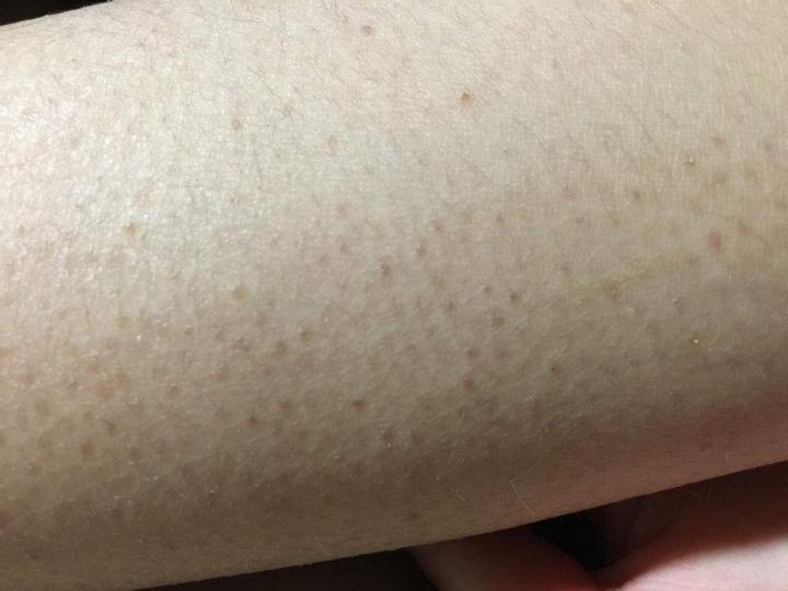 如何有效去鸡皮?3招教你和鸡皮说再见