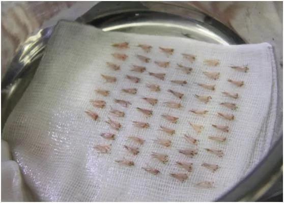 m型脱发1-7级程度图片,m型脱发后长出绒毛能恢复吗