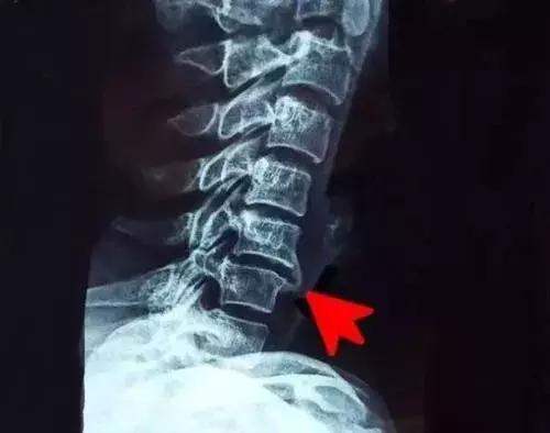 长骨刺用什么方法治疗最好,腰椎长骨刺最好的治疗方法