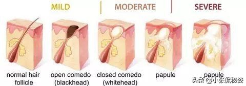 去黑头粉刺痘痘的面膜推荐,男士清洁面膜推荐去黑头收缩毛孔