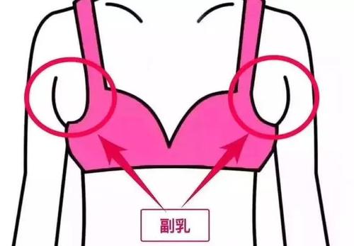 副乳里面有硬块要切除吗,副乳在腋窝下存在什么风险