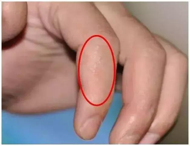 天热手上起水泡怎么回事,天气一热手上就长小水泡怎么回事