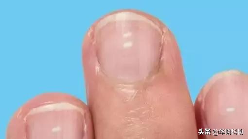 指甲上没月牙有横线长倒刺,关于指甲的科普指甲上的疾病视频